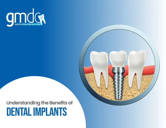 Benefits of Dental Implants